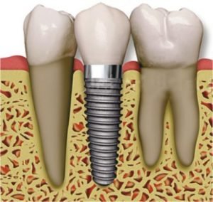 How do dental implants replace teeth