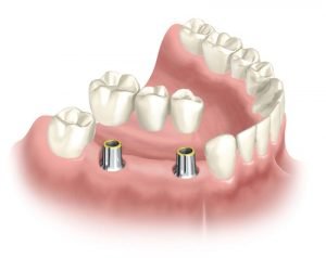 Implant Supported Bridge