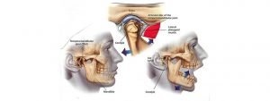 Read more about the article TemporoMandibular Joint Dysfunction Syndrome (TMJPDS) explained