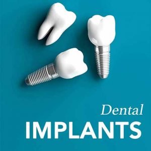 Dental Implants In Sunnybank Hills