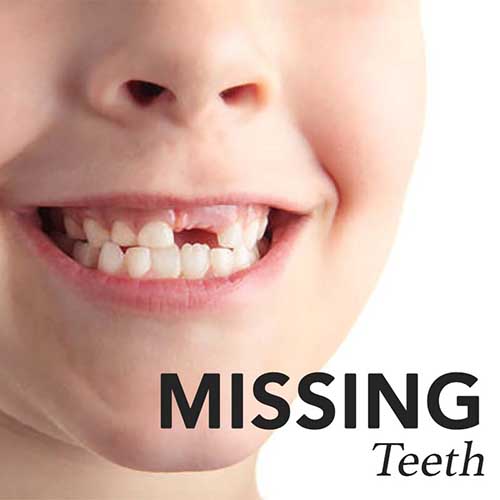 Missing Teeth