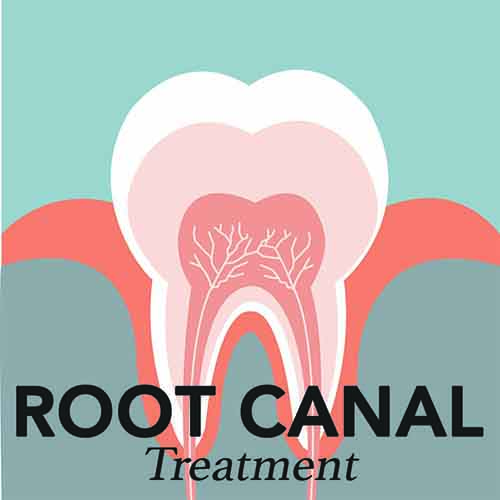 Root Canal Treatment