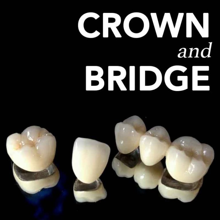 Crown and Bridge