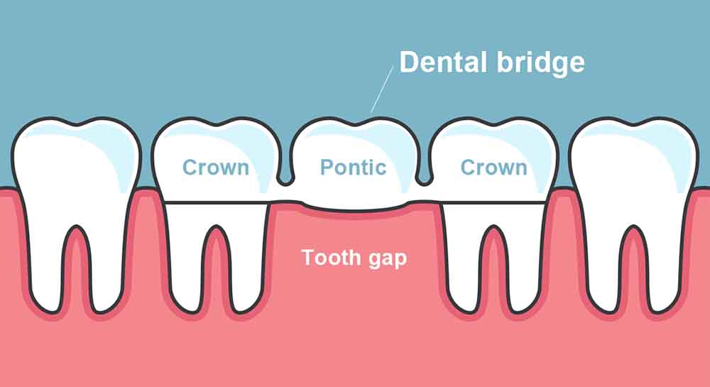 Dental Bridge Dentist Sunnybank Hills