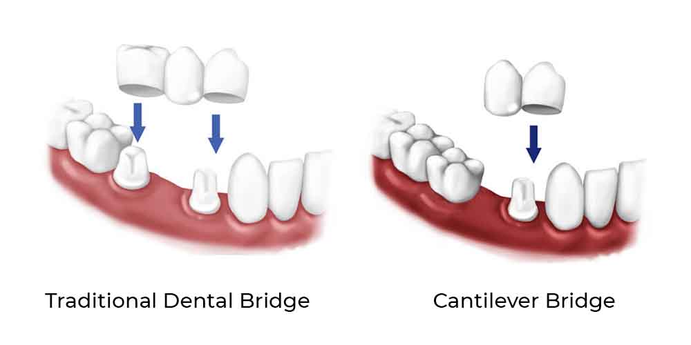 Dental Bridge Types Sunnybank Hills