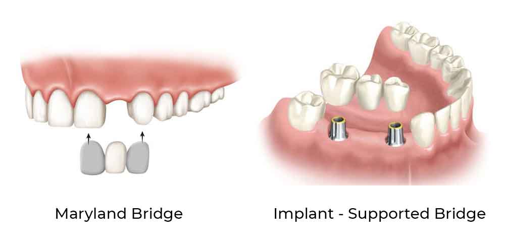 Dental Bridge Types Sunnybank Hills