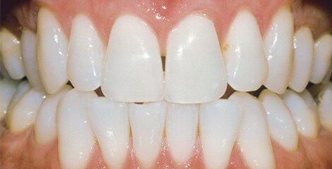 zoom-teeth-whitening-after zoom-teeth-whitening-after