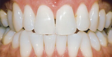 zoom-teeth-whitening-after