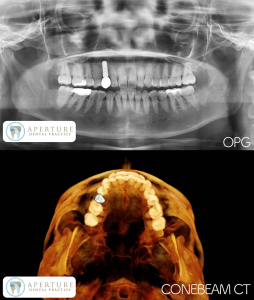 OPG and Cone Beam CT