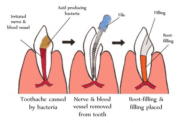 Root Canal Treatment