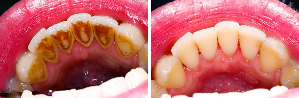 Scaling Your Teeth