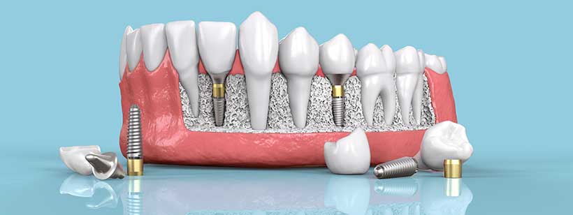 You are currently viewing How do DENTAL IMPLANTS Replace Teeth?