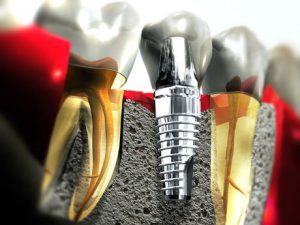 Dental Implant