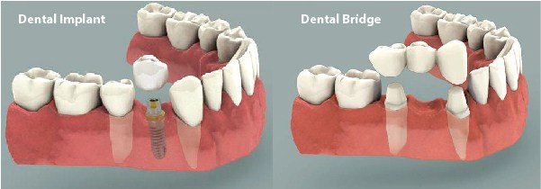 Difference between Dental Implant and Dental Bridge