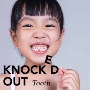 Knocked-Out Tooth