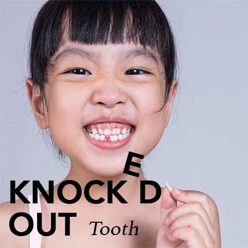 Knocked-Out Tooth
