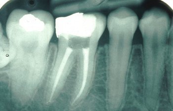 X-ray of Root Canal Treated Tooth