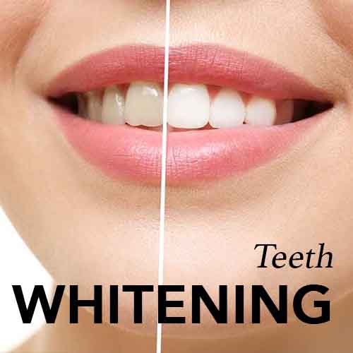 Teeth Whitening Sunnybank Hills