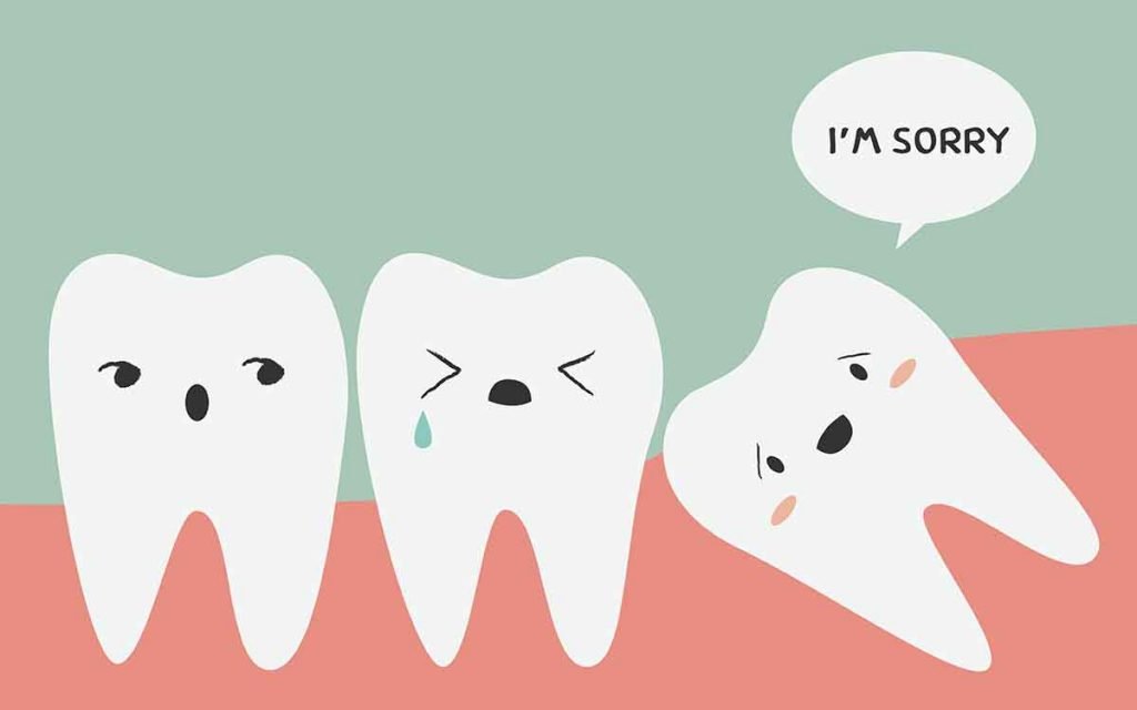 Impacted Wisdom Teeth