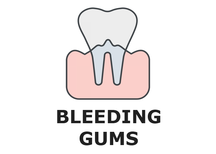 Bleeding Gums