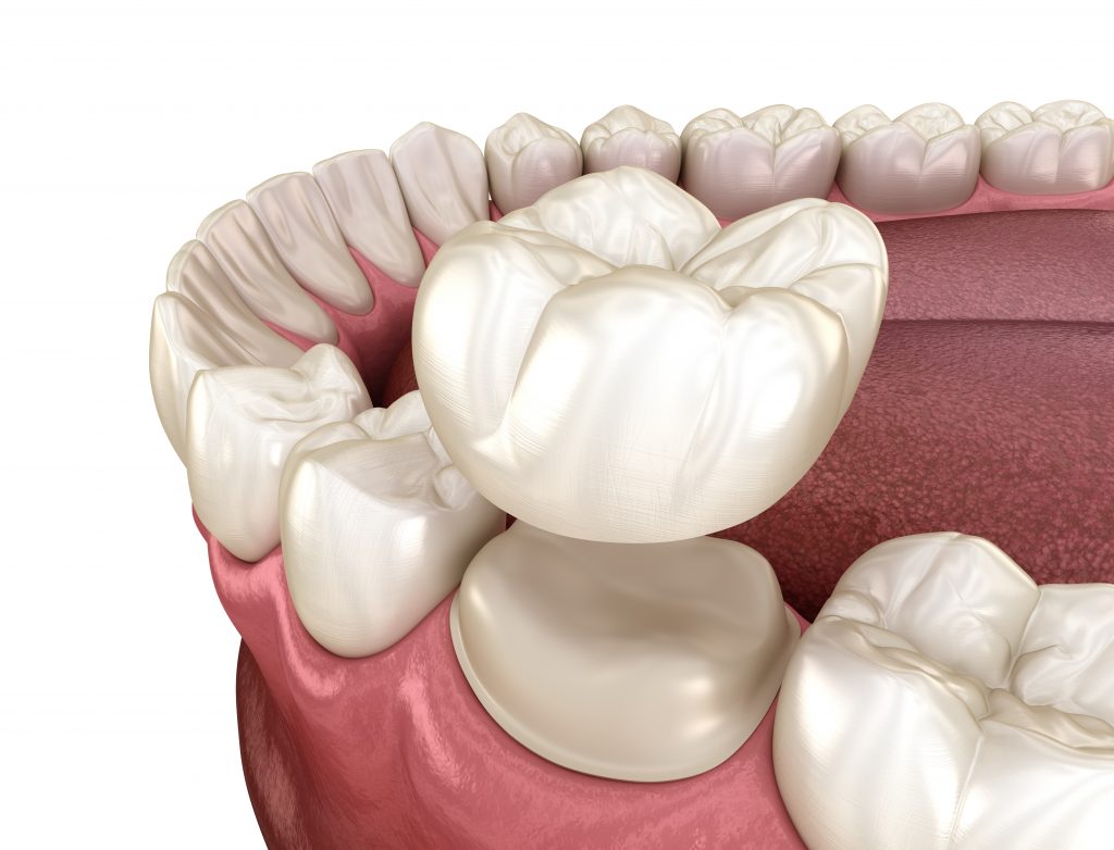 Same Day dental crown Sunnybank Hills