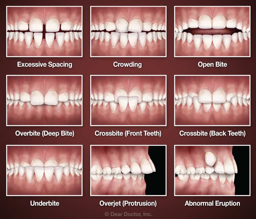 When Should You Straighten Your Teeth? - Aperture Dental Practice