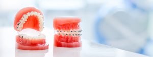 Read more about the article What Happens During Orthodontic Treatment?