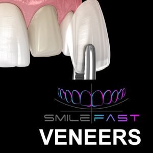 Composite & Porcelain Veneers Sunnybank