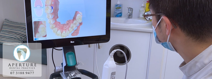 Read more about the article What is the iTero Intraoral Scanner?