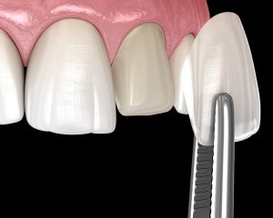 Affordable cosmetic dentistry: A dental porcelain veneer is placed over a tooth