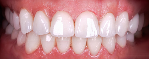 veneers-old-lady-after veneers-old-lady-after