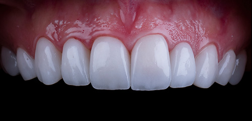 veneers-porcelain-after veneers-porcelain-after