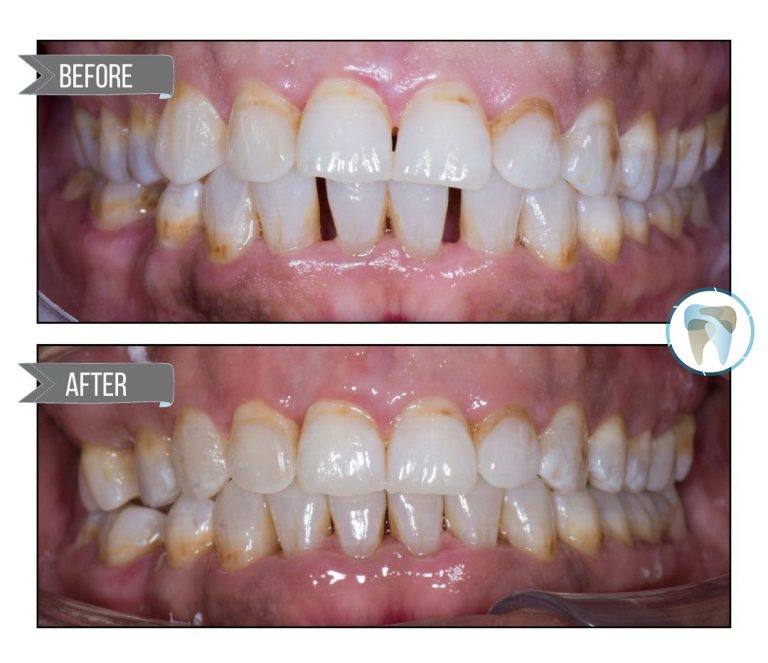 Aperture-Dental-clear-aligners-before-after-2a