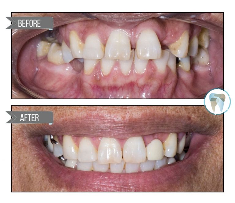 Aperture-Dental-clear-aligners-before-after-3a