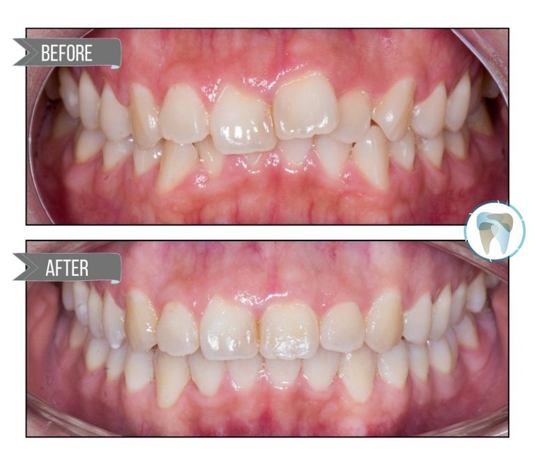 Aperture-Dental-clear-aligners-before-after-7a