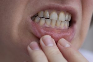 Read more about the article What Is Calculus On Teeth?