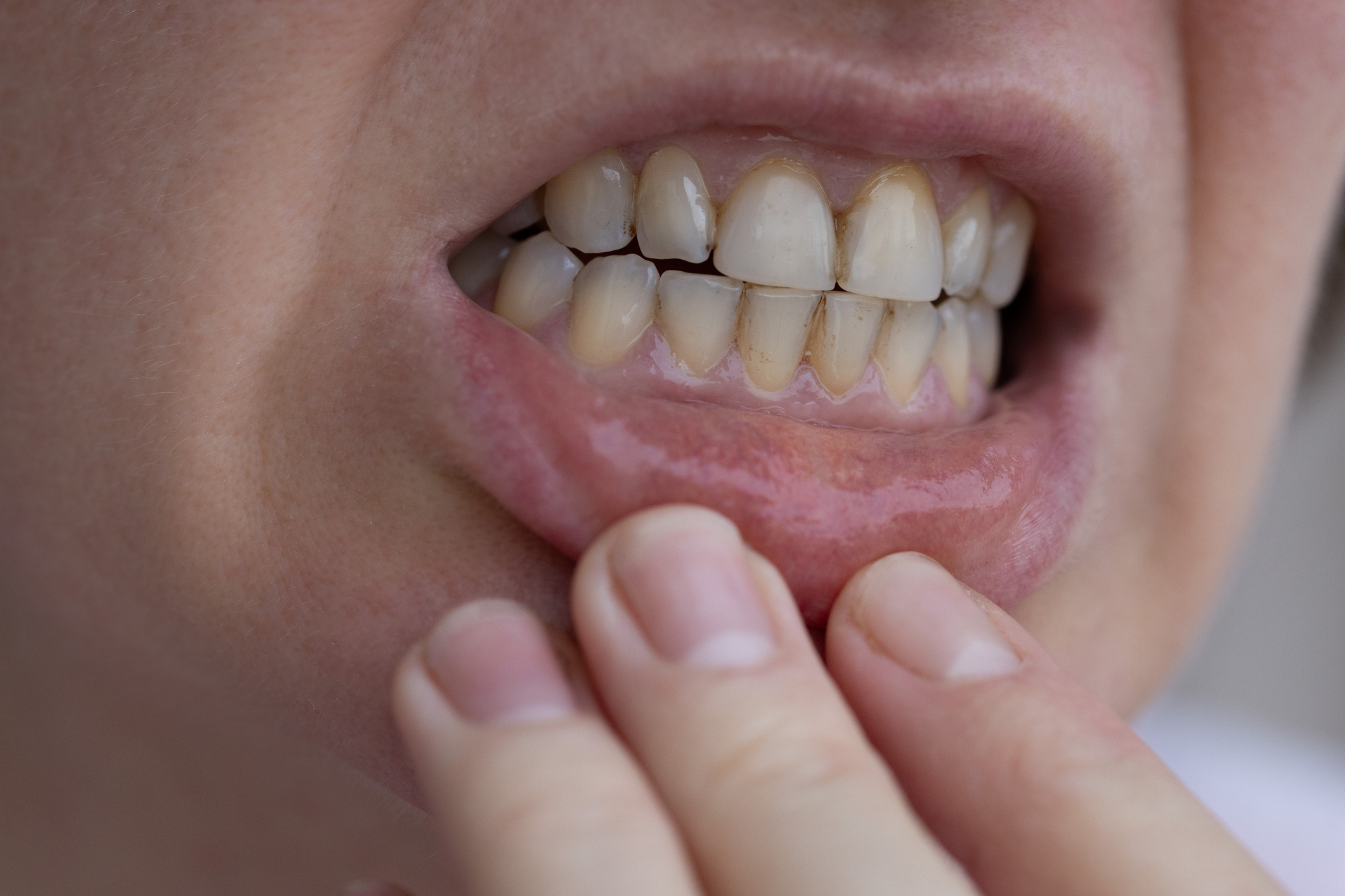 Read more about the article What Is Calculus On Teeth?