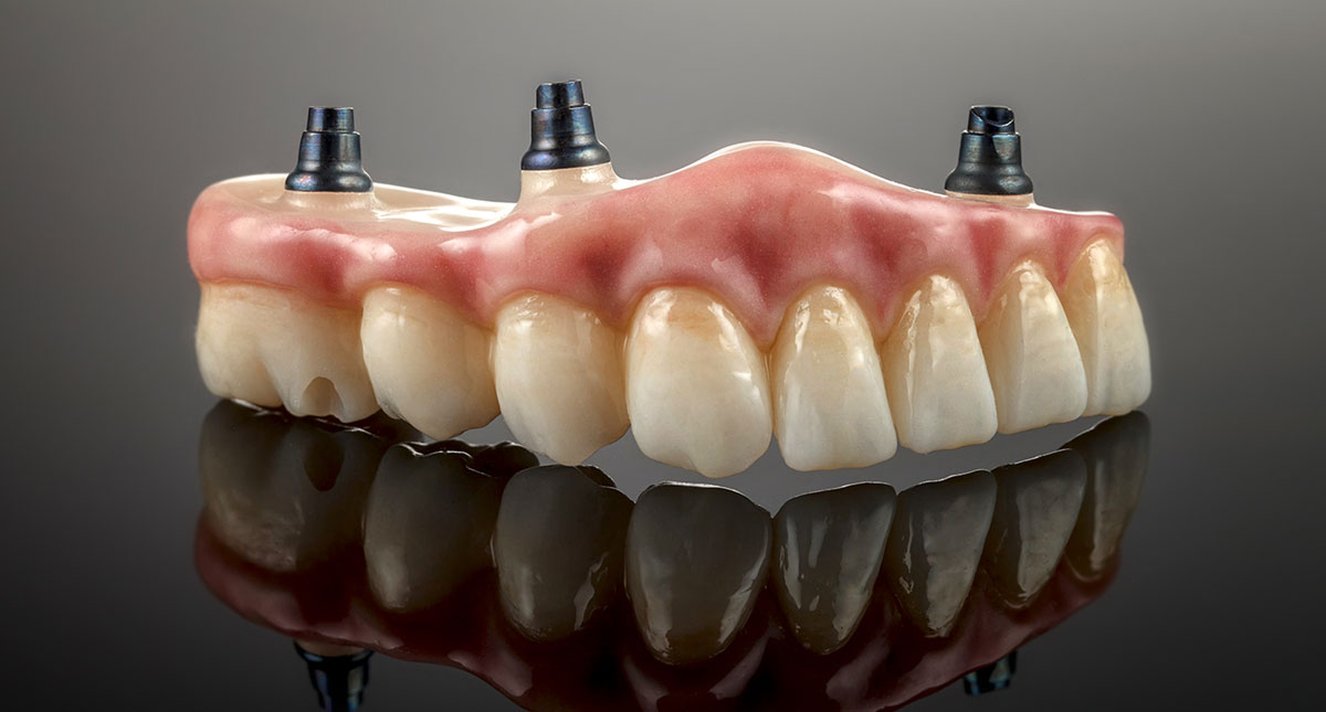 Read more about the article What Are Implant-Retained Dentures? Your Complete Guide to a Secure Smile